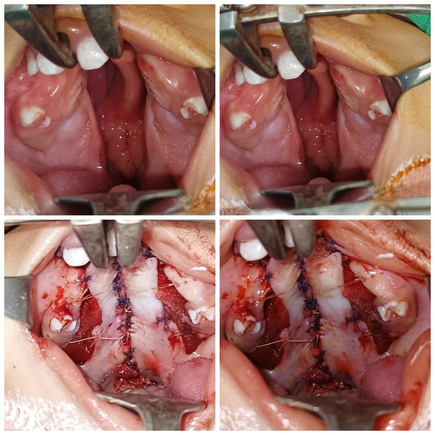 cleft palate